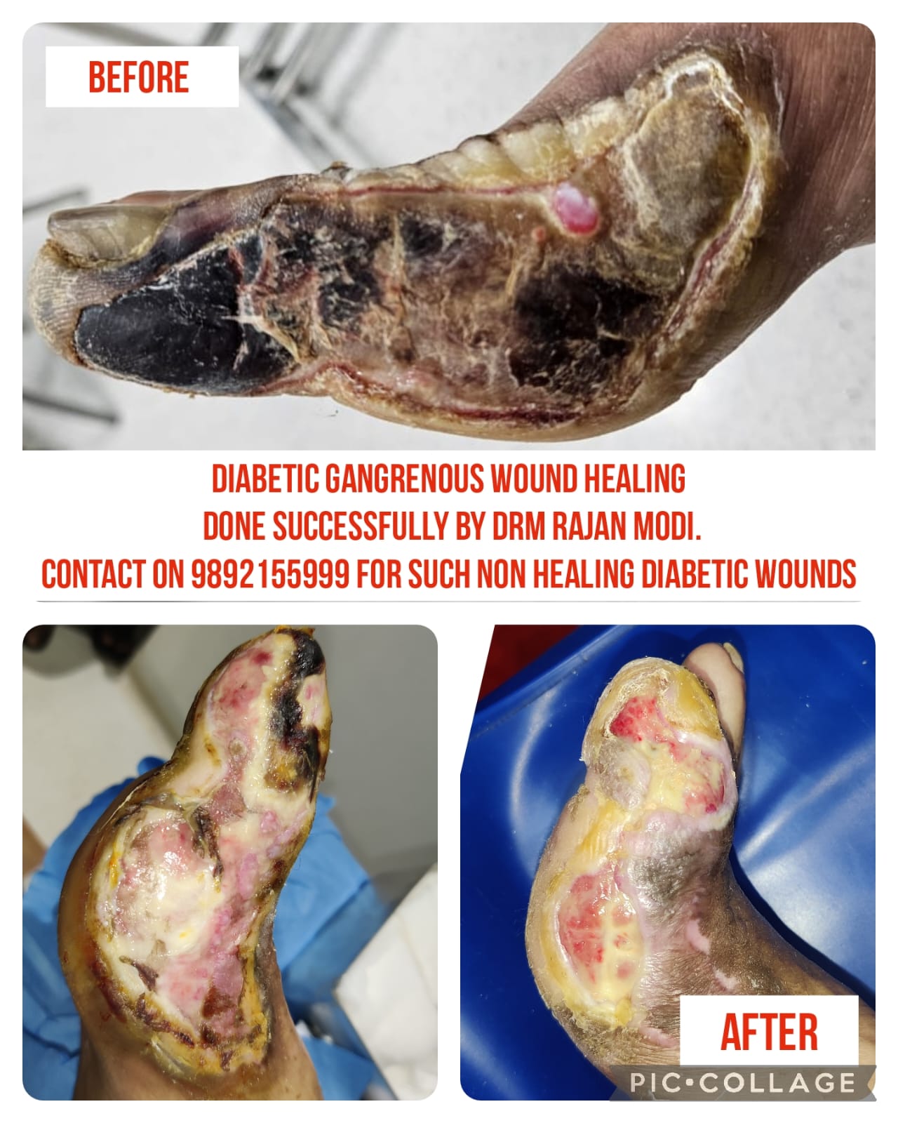 diabetic foot